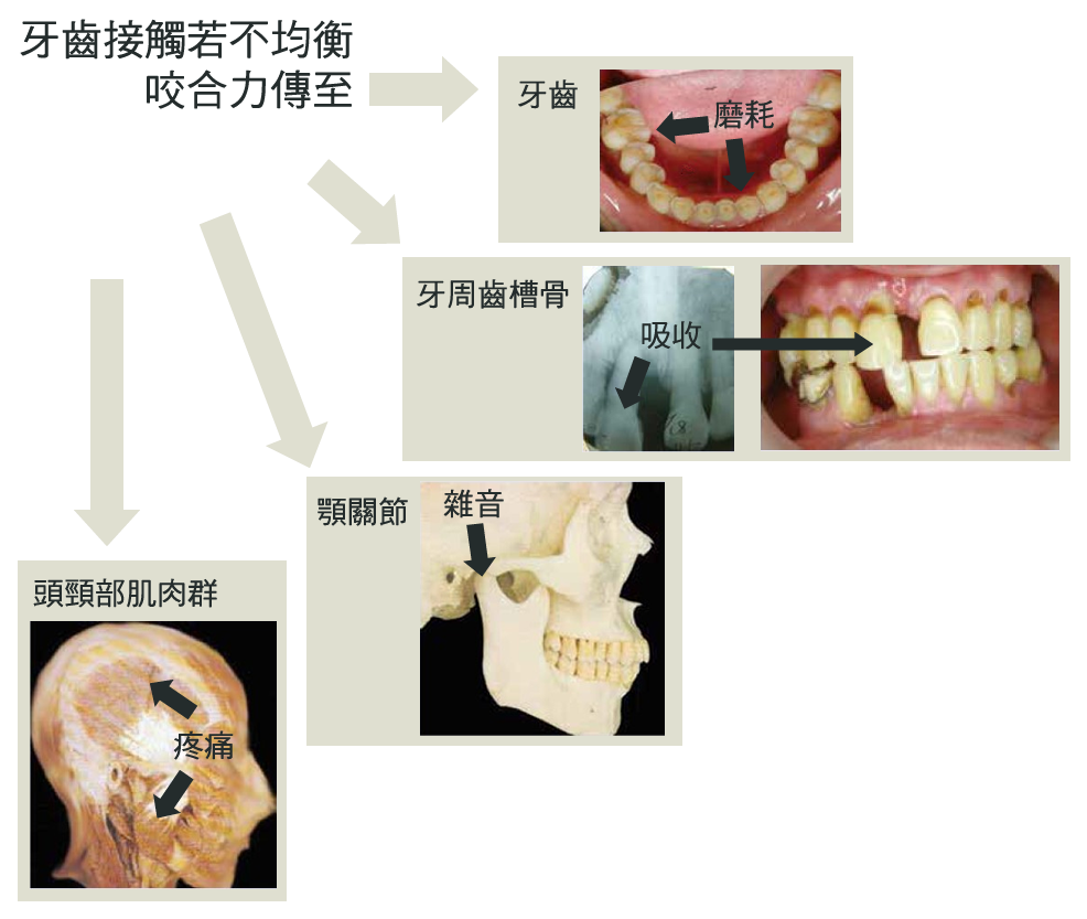 咬合傷害